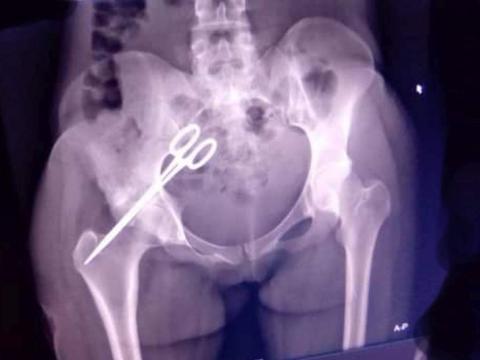 Xray film of patient Xray film of patient